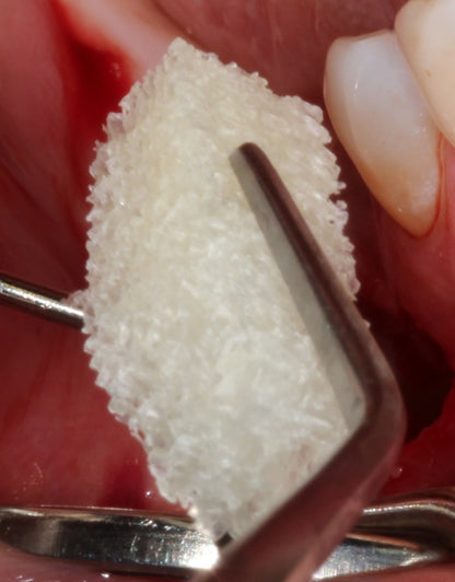 OSSIFY™ Demineralized Sponge Strip Allograft